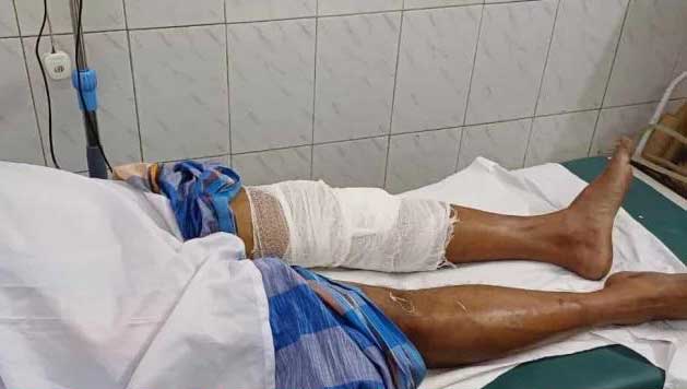 মাকে হাসপাতালে নিয়ে যাওয়ার সময় ছেলের পা ভেঙে দিলো পতিপক্ষ