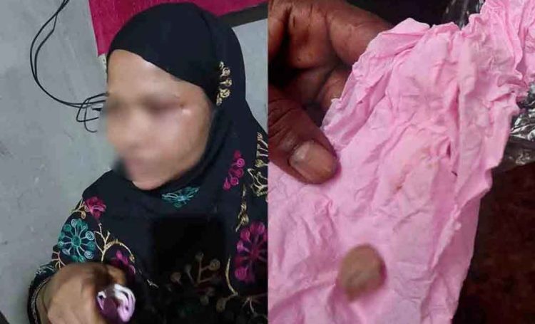 ঝালকাঠিতে চোরের আঙুল কামড়ে বিচ্ছিন্ন করলেন গৃহবধূ